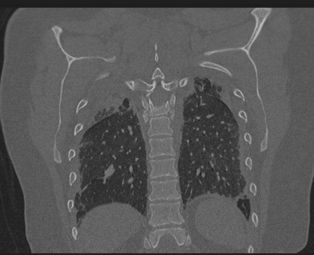 Burst fracture - thoracic spine (Radiopaedia 30238-30865 Coronal bone window 126).jpg