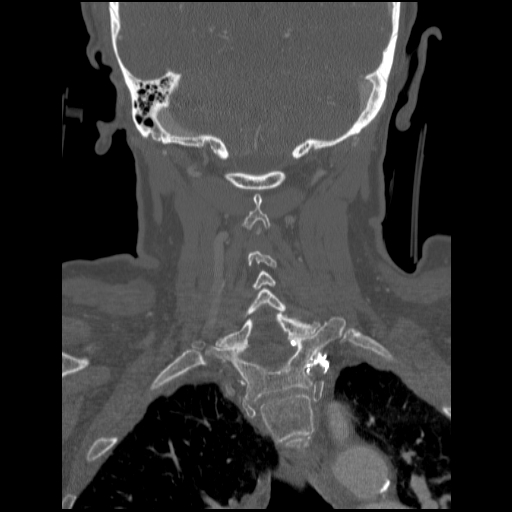 File:C1 anterior arch (plough) fracture - type 1 (Radiopaedia 76181-87720 Coronal bone window 34).jpg