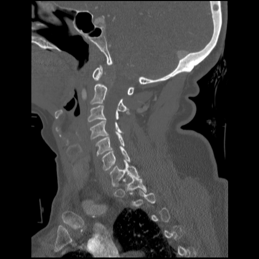 File:C1 anterior arch (plough) fracture - type 1 (Radiopaedia 76181-87720 Sagittal bone window 66).jpg