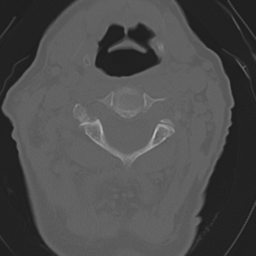 File:C2 fracture with vertebral artery dissection (Radiopaedia 37378-39199 Axial bone window 20).png