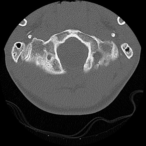 File:C5 facet fracture (Radiopaedia 58374-65499 Axial bone window 7).jpg