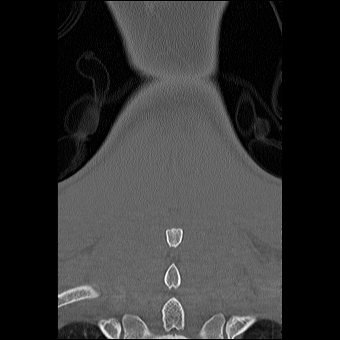 C5 facet fracture (Radiopaedia 58374-65499 Coronal bone window 56).jpg