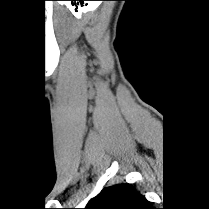 C5 facet fracture (Radiopaedia 58374-65499 D 12).jpg