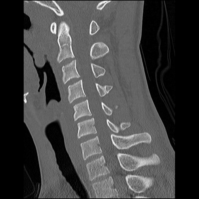 C5 facet fracture (Radiopaedia 58374-65499 Sagittal bone window 35).jpg