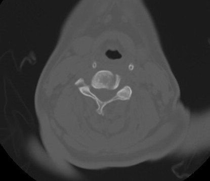 C7 laminar fracture and Klippel-Feil syndrome (Radiopaedia 86710-102850 Axial bone window 43).jpg