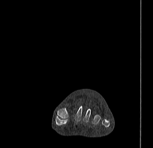 Calcaneal fracture - Sanders type 4 (Radiopaedia 90179-107370 Coronal bone window 24).jpg