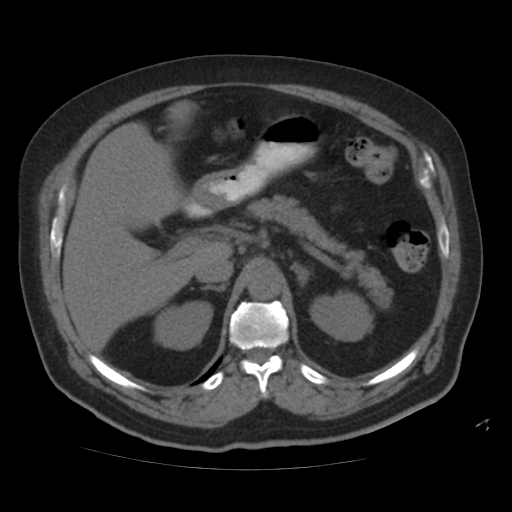 File:Calcified hepatic hydatid cyst (Radiopaedia 18907-18853 Axial non-contrast 17).jpg