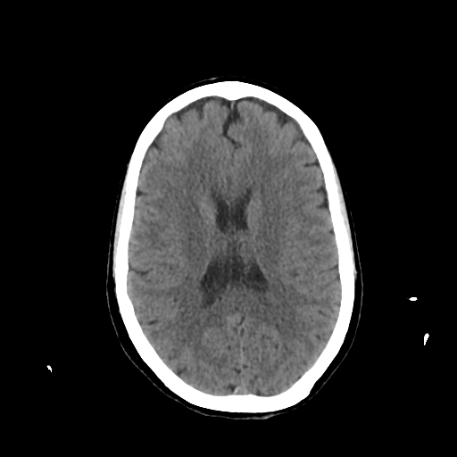 File:Calcified meningioma - cervical canal (Radiopaedia 70136-80171 Axial non-contrast 16).jpg