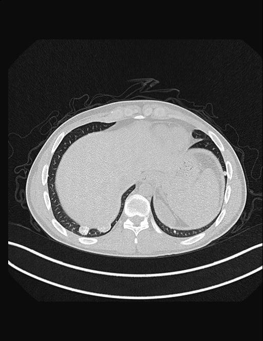 Calcifying pulmonary metastases (Radiopaedia 33359-34396 Axial lung window 53).jpg