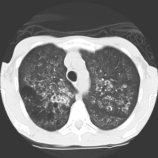 File:Calciphylaxis and metastatic pulmonary calcification (Radiopaedia 10887-11317 Axial lung window 9).jpg