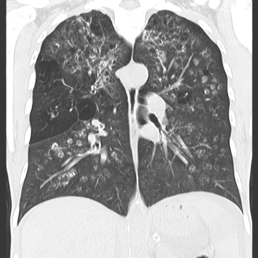 File:Calciphylaxis and metastatic pulmonary calcification (Radiopaedia 10887-11318 Coronal lung window 6).jpg
