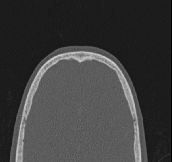 Caldwell-Luc operation (Radiopaedia 52329-58225 Axial bone window 2).jpg