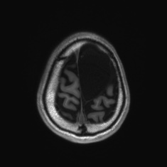 Callosal dysgenesis with interhemispheric cyst (Radiopaedia 53355-59335 Axial T1 139).jpg