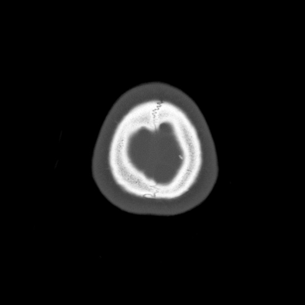 Calvarial osteoma (Radiopaedia 36520-38079 Axial bone window 105).jpg