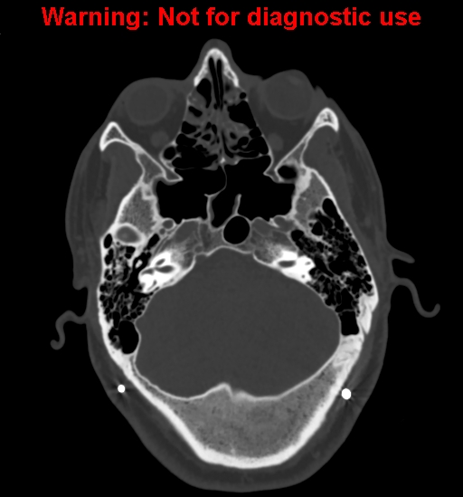 File:Calvarial thickening from chronic shunting (Radiopaedia 60079-67637 Axial bone window 42).jpg
