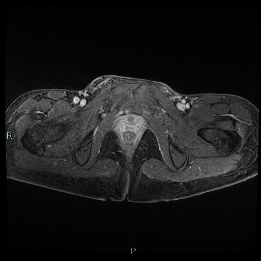 File:Canal of Nuck cyst (Radiopaedia 55074-61448 Axial T1 C+ fat sat 48).jpg