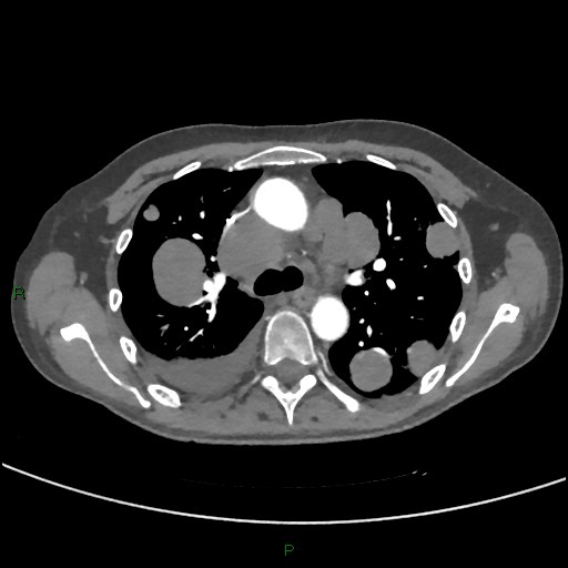Cannonball metastases (Radiopaedia 82110-96150 Axial C+ CTPA 126).jpg