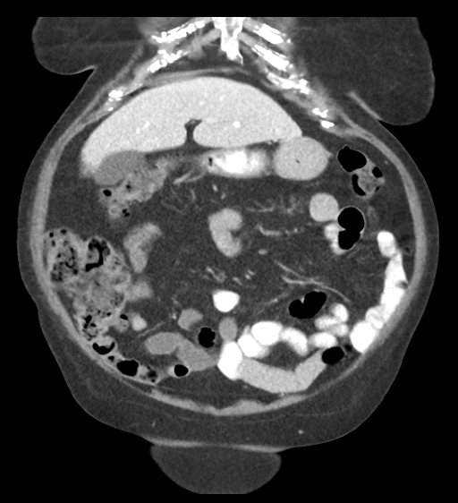 Cannonball metastases from endometrial cancer (Radiopaedia 42003-45031 F 21).png