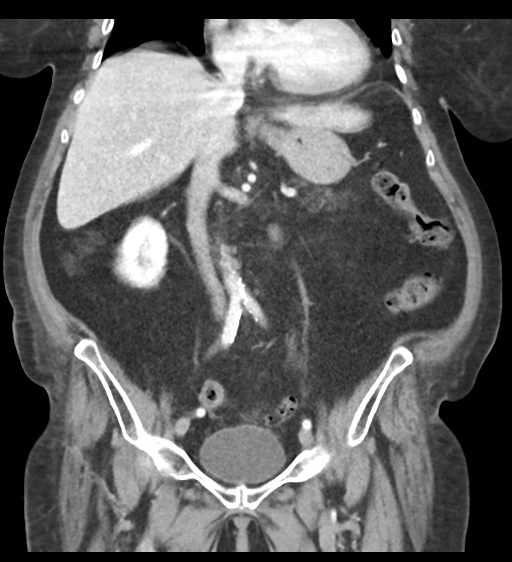 Cannonball metastases from endometrial cancer (Radiopaedia 42003-45031 F 35).png