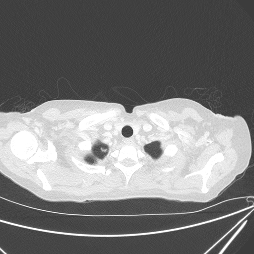 Canonball lung metastasis (Radiopaedia 77634-89837 Axial lung window 15).jpg