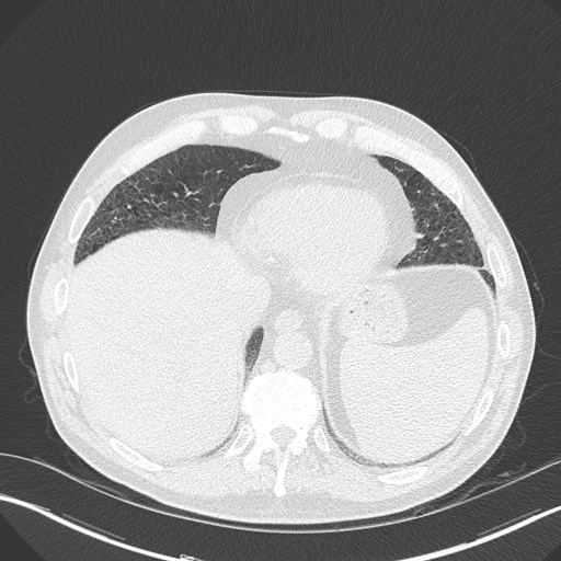 Caplan syndrome (Radiopaedia 56667-63530 Axial lung window 155).jpg
