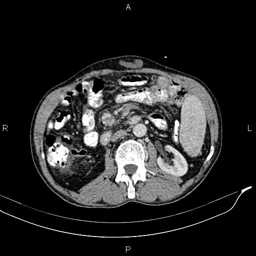 File:Caput medusae sign - portal hypertension (Radiopaedia 64007-72759 A 42).jpg