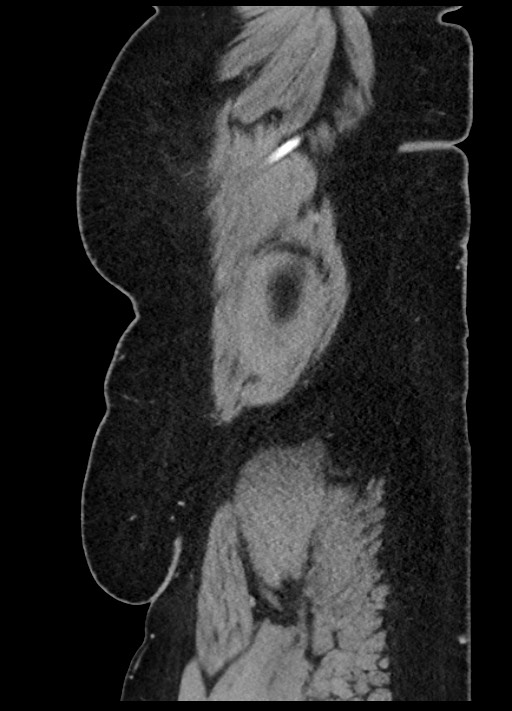 Carcinoid tumor - terminal ileum (Radiopaedia 60931-68739 C 100).jpg