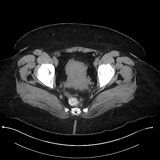 File:Carcinoid tumor - terminal ileum (Radiopaedia 60931-68740 Axial non-contrast 113).jpg
