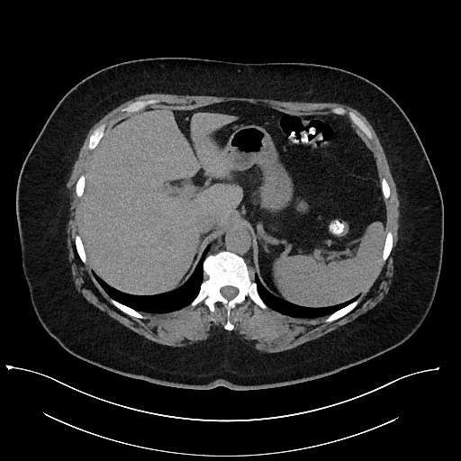 Carcinoid tumor - terminal ileum (Radiopaedia 60931-68740 Axial non-contrast 19).jpg