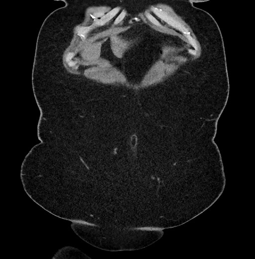 Carcinoid tumor - terminal ileum (Radiopaedia 60931-68740 Coronal non-contrast 6).jpg