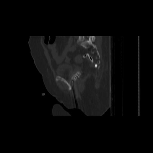File:Carcinoma cervix- brachytherapy applicator (Radiopaedia 33135-34173 Sagittal bone window 113).jpg