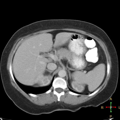 File:Carcinoma of sigmoid colon (Radiopaedia 23071-23100 B 5).jpg