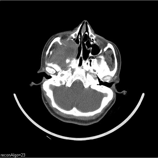 File:Carcinoma of the maxillary antrum (Radiopaedia 53805-59888 Axial C+ delayed 58).jpg