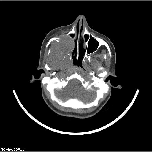 Carcinoma of the maxillary antrum (Radiopaedia 53805-59888 Axial non-contrast 61).jpg