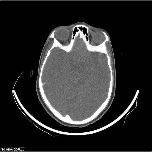 Carcinoma of the maxillary antrum (Radiopaedia 53805-59888 Axial non-contrast 77).jpg
