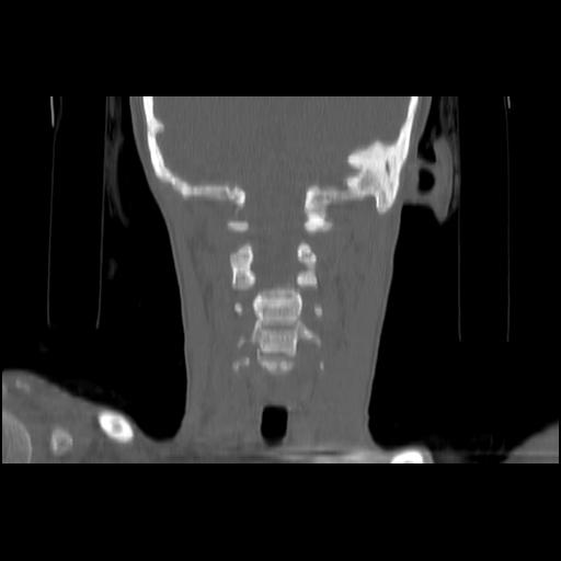 Carcinoma of the maxillary antrum (Radiopaedia 53805-59888 Coronal bone window 105).jpg