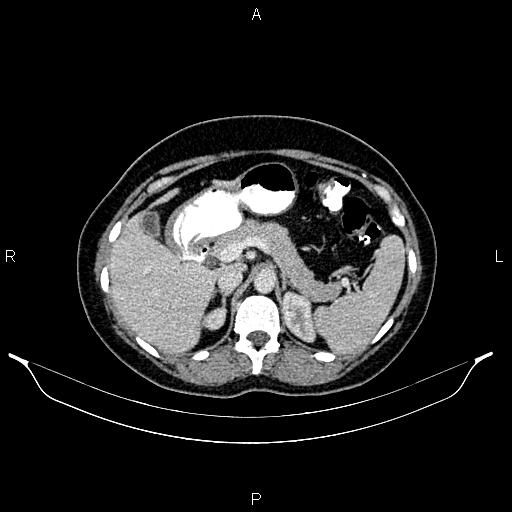 Carcinoma of uterine cervix (Radiopaedia 85861-101700 A 38).jpg