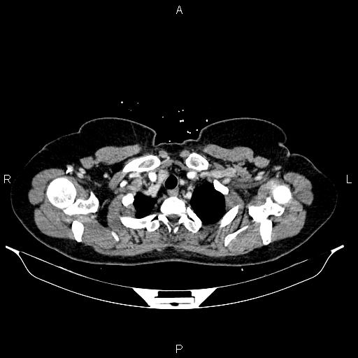 Carcinoma of uterine cervix (Radiopaedia 85861-101700 A 8).jpg