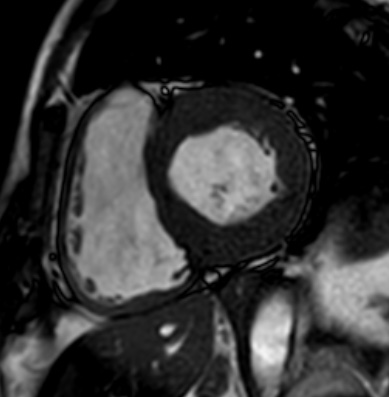 Cardiac amyloidosis - ATTR wild-type (Radiopaedia 74412-85296 short axis cine SSFP 121).jpg