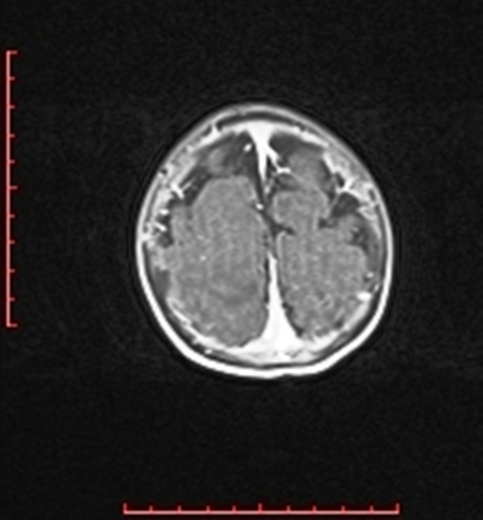 Cardiac rhabdomyoma - tuberous sclerosis (Radiopaedia 70089-80114 Axial T1 C+ fat sat 98).jpg