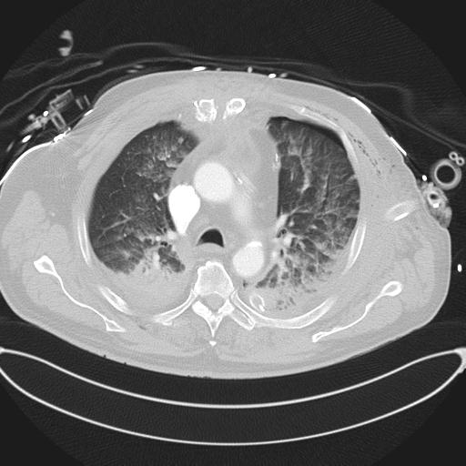 Cardiac trauma (Radiopaedia 32874-33858 Axial lung window 19).jpg