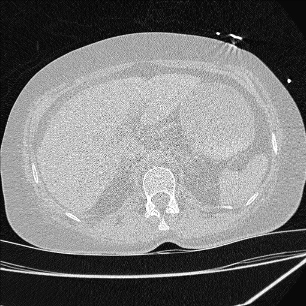Cardiogenic pulmonary edema (Radiopaedia 29213-29609 Axial lung window 112).jpg