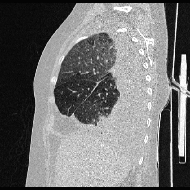 Cardiogenic pulmonary edema (Radiopaedia 29213-29609 Sagittal lung window 25).jpg