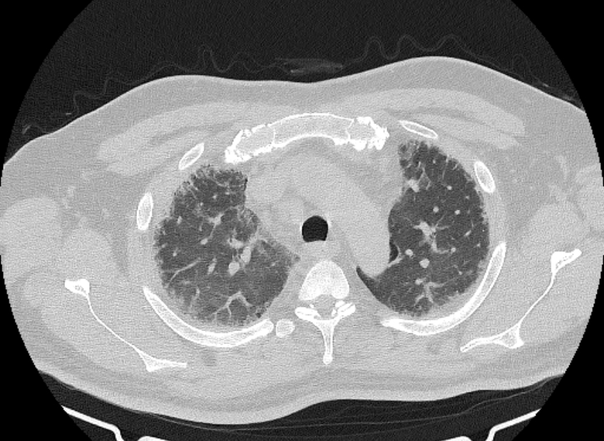 Cardiogenic pulmonary edema (Radiopaedia 68180-77678 Axial lung window 18).jpg