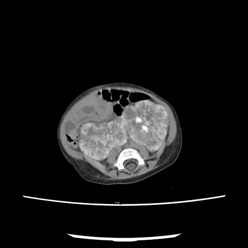 Caroli disease with autosomal recessive polycystic kidney disease (ARPKD) (Radiopaedia 89651-106703 E 163).jpg