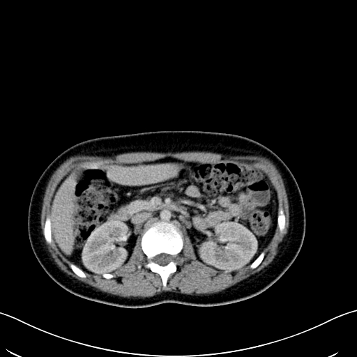 Caroli disease with medullary sponge kidney (Radiopaedia 82622-96804 C 29).jpg