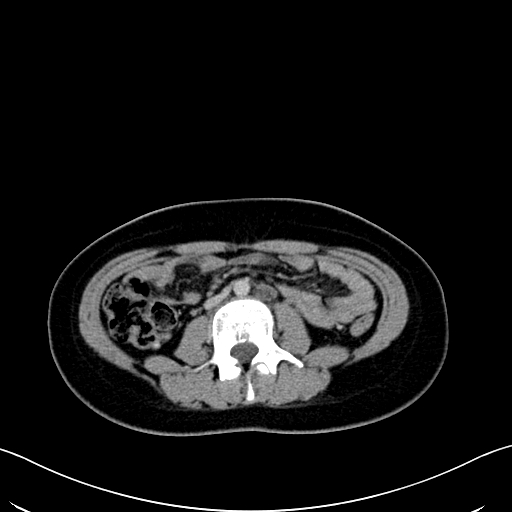 Caroli disease with medullary sponge kidney (Radiopaedia 82622-96804 C 39).jpg