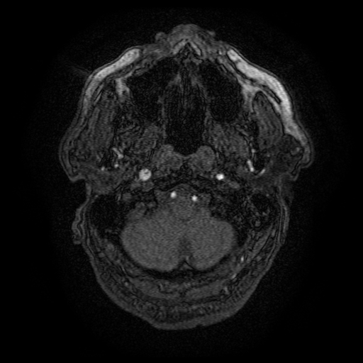 File:Carotid arterial dissection with acute cerebral infarction (Radiopaedia 26636-26784 MRA 163).jpg