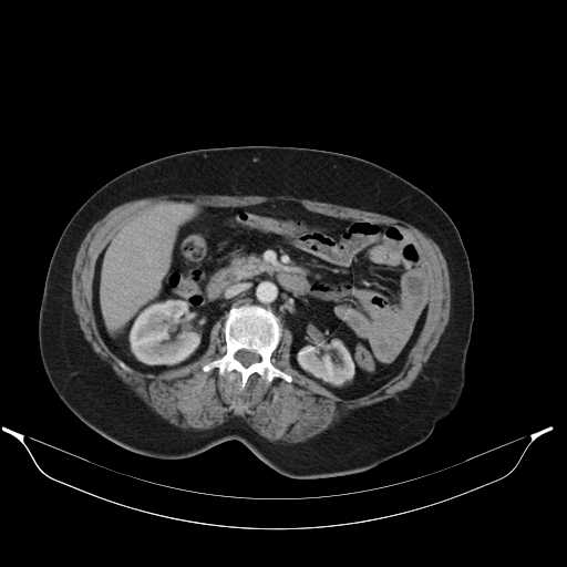 Carotid body tumor (Radiopaedia 21021-20948 A 64).jpg