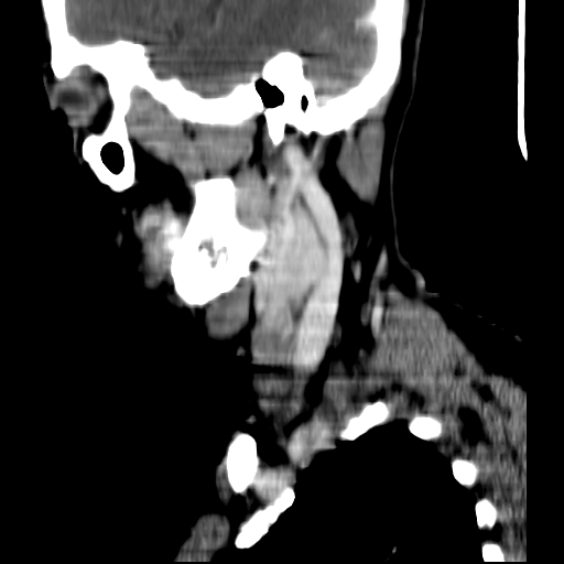 File:Carotid body tumor (Radiopaedia 27890-28124 C 21).jpg